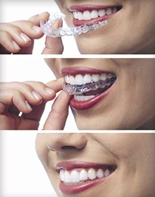 Invisalign Clear Braces for Straight Teeth in Kennesaw - Invisalign  Treatment near Acworth - Clear Aligners