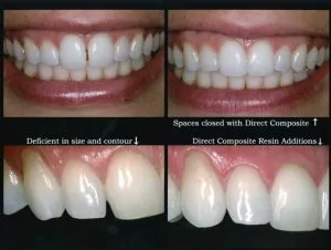A patient of Russell G. Anderson DMD before and after recieving cosmetic dentistry treatment.