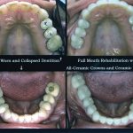 crowns-veneers-1