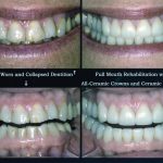 crowns-veneers-2