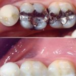 fillings-1