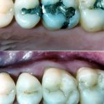 fillings-2