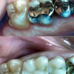 fillings-3