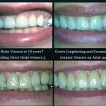 veneers-1