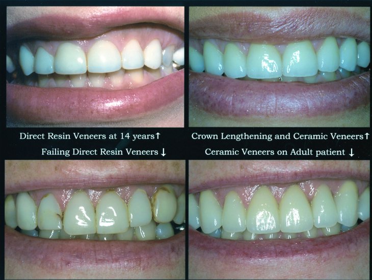 Before and after photos from an Acworth teeth veneers patient near Acworth.