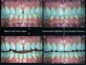 A Kennesaw dental patient before and after dental veneers.