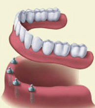 All-on-4 Dental Implants graphic.