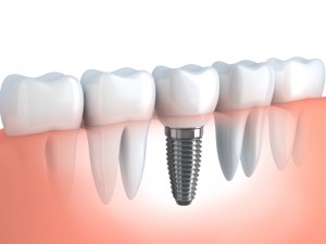 Teeth implants and implant dentistry in Kennesaw and Acworth GA.