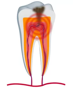 Cross-section of a tooth, revealing a tooth infection in need of a root canal.