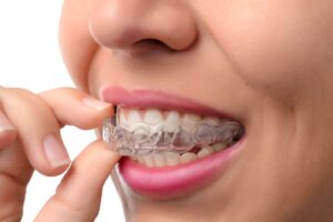 A young woman inserting an Invisalign aligner.