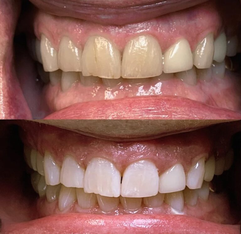 Your Summer Is Calling — Is Your Smile Ready?