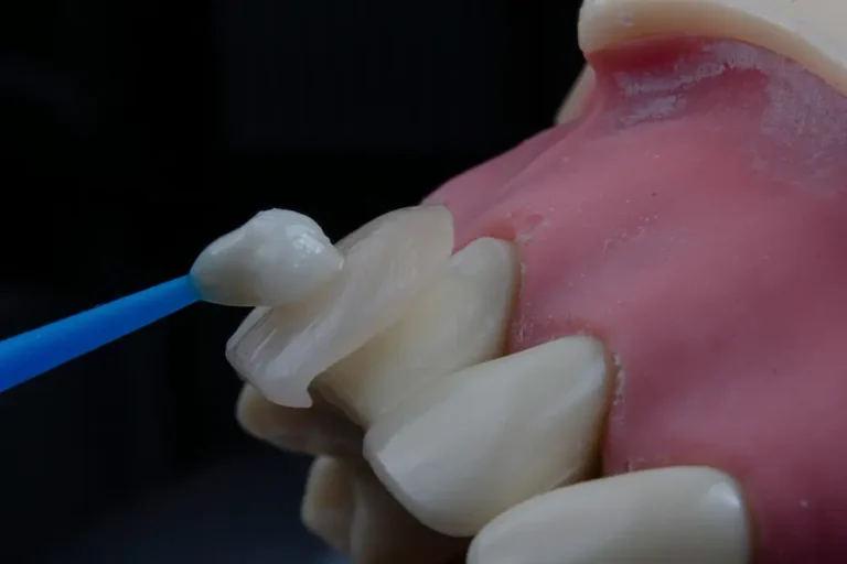 acworth dentist fixing a chipped tooth with a porcelain veneer