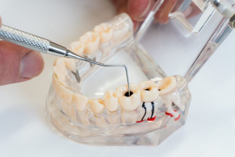 kennesaw dentist demonstrating root canal procedure