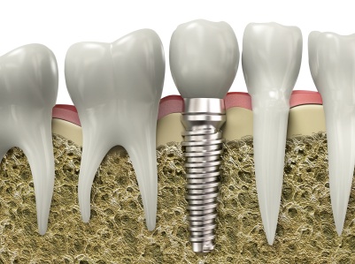 A graphic image of a dental implant placed in a jawbone in Kennesaw.