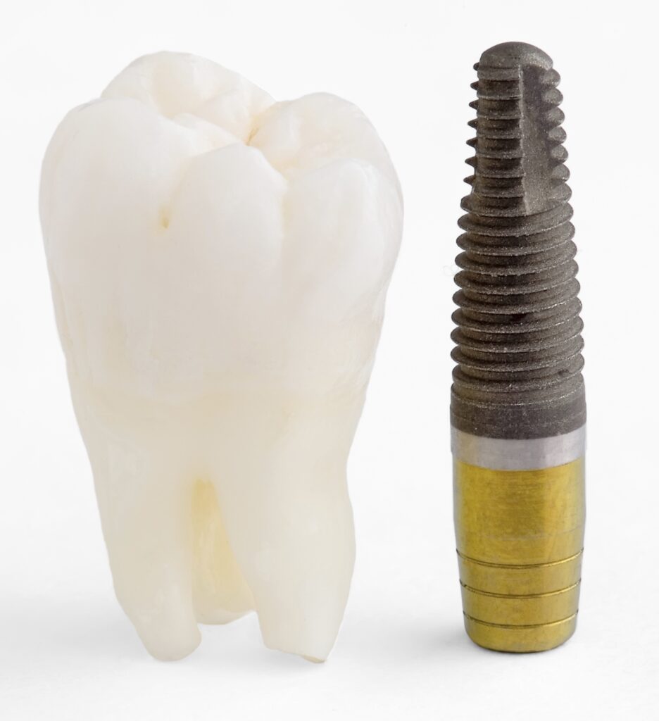 A dental implant base next to a tooth, a common treatment for tooth loss in Kennesaw.